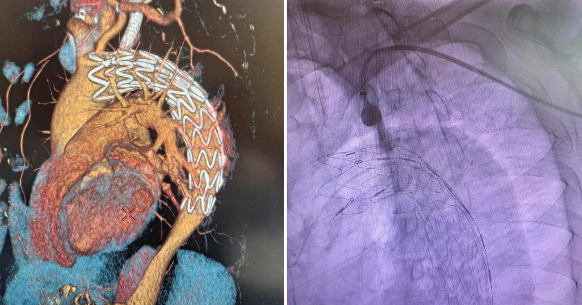 ПРВПАТ ВО МАКЕДОНИЈА ВО „АЏИБАДЕМ СИСТИНА“ ИЗВЕДЕНА КОМПЛЕКСНА ЕНДОВАСКУЛАРНА ПРОЦЕДУРА НА ТОРАКАЛНАТА АОРТА – ТЕВАР СО Т.Н. IN SITU ФЕНЕСТРАЦИЈА