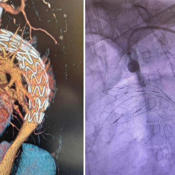 ПРВПАТ ВО МАКЕДОНИЈА ВО „АЏИБАДЕМ СИСТИНА“ ИЗВЕДЕНА КОМПЛЕКСНА ЕНДОВАСКУЛАРНА ПРОЦЕДУРА НА ТОРАКАЛНАТА АОРТА – ТЕВАР СО Т.Н. IN SITU ФЕНЕСТРАЦИЈА